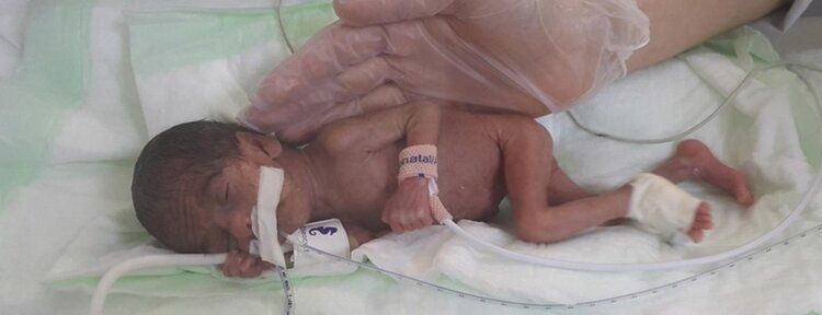 465 gram doğan bebek tedavi ile hayata tutundu